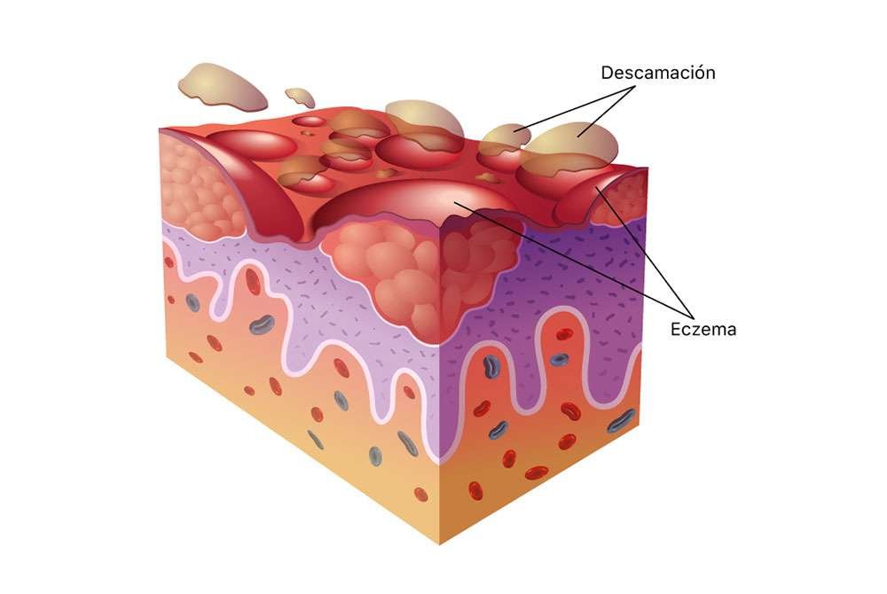 Tratamiento natural de la dermatitis alérgica para los 20. Lidiar con la dermatitis puede ser molesto, doloroso y puede causar ansiedad.