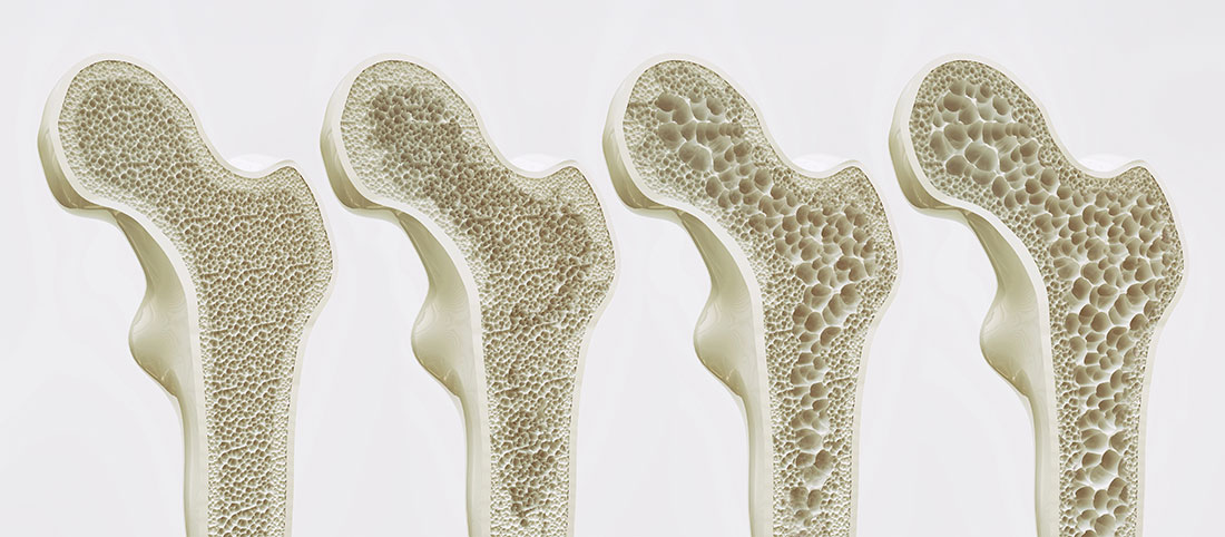 Osteoporosis. Cuida tus huesos para ganar calidad de vida